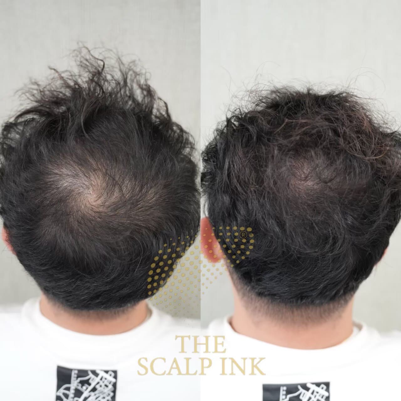 男性のつむじのビフォーアフター