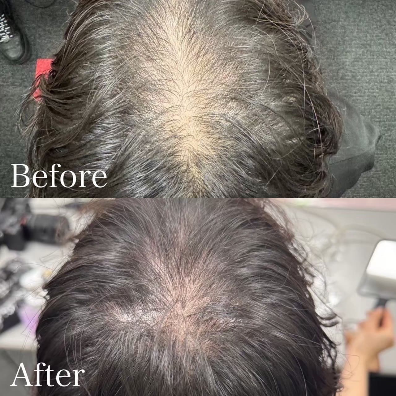 女性の頭頂部のビフォーアフター